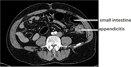 Left-sided high-positioned appendicitis.