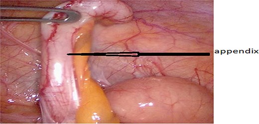 Retrocecal appendicitis with minimal peritoneal effusion.