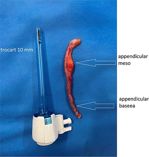 Appendectomy.