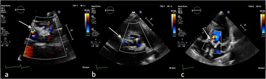 Antero-septal paravalvular leak (PVL) of the prosthetic aortic valve in TTE (a) TTE PLAX (b), PSAX (c) 5CV (day 21 of hospitalization).