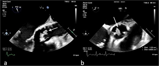 (a) Large vegetation on the neo-right coronary cusp of the aortic prosthetic valve in TEE LAX and (b) TEE SAX (day 11 of hospitalization).