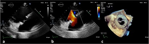 (a) No vegetation, valve destruction of the prosthetic tricuspid valve on TTE RV inflow view, (b) No PVL of the prosthetic TV (TTE color doppler), (c) no signs of prosthetic IE on TV in TEE (day 21 of hospitalization).