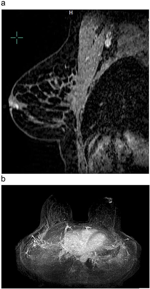 (a) Magnetic resonance imaging sagittal view of the left breast showing a retroareolar lesion. The lesion enhancement appears to align in a duct in the retroareolar breast. (b) Magnetic resonance imaging axial view of the left breast retroareolar lesion. The lesion enhancement appears to align in a duct in the retroareolar breast.