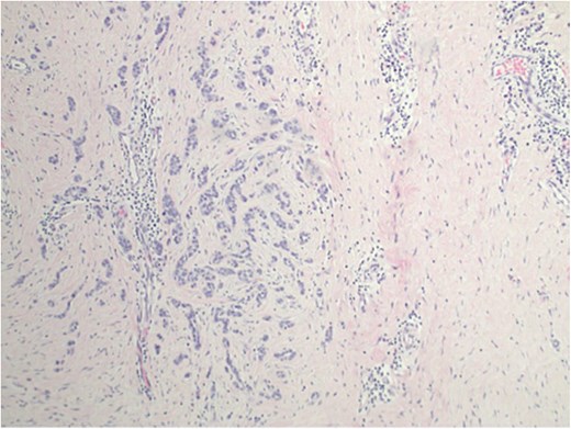 Hematoxylin and eosin stain showing invasive ductal carcinoma tumor cells infiltrating into the deep derms of the overlaying nipple.