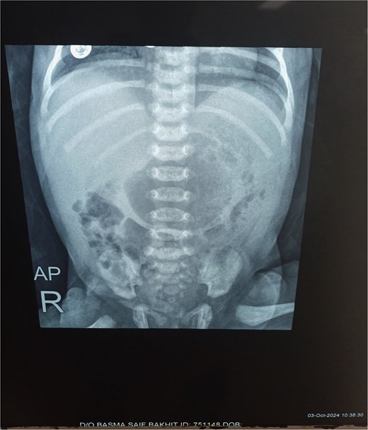 Pre-operative abdominal X-ray.