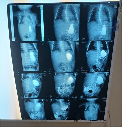 The contrast study done pre-operatively showing the progression of the contrast in the digestive tract of the neonate.