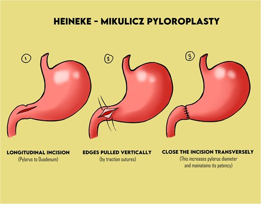 An illustration of the Heinke-Mikulicz pyloroplasty.