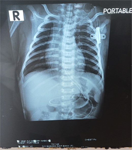 Post-operative X-ray showing no air under diaphragm.