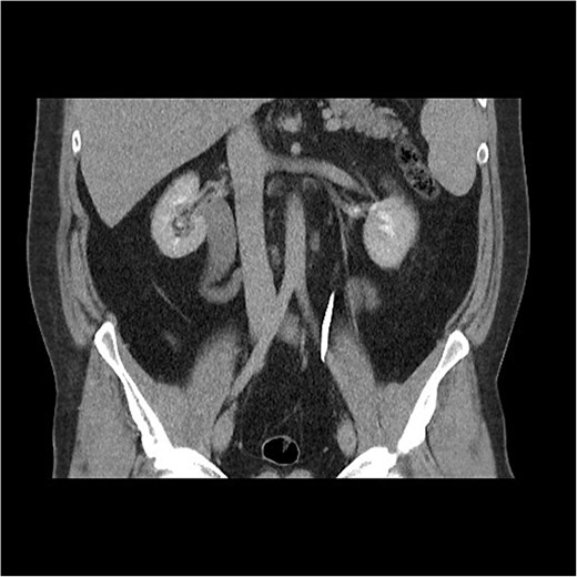 CT abdomen shows an S-shaped ureter with the right ureter passing behind the IVC.
