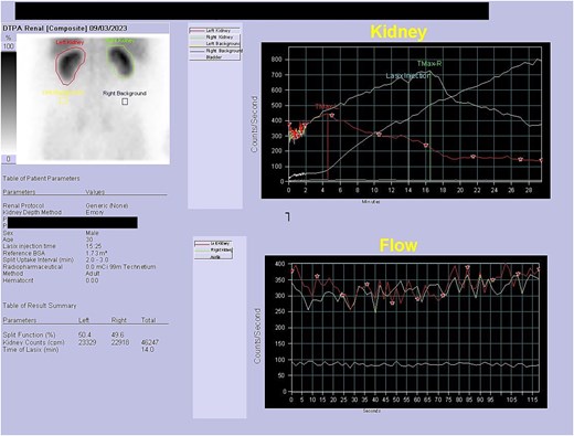 DTPA scan showing partially obstructed or hypotonic right kidney with resolution of obstruction following diuretic.