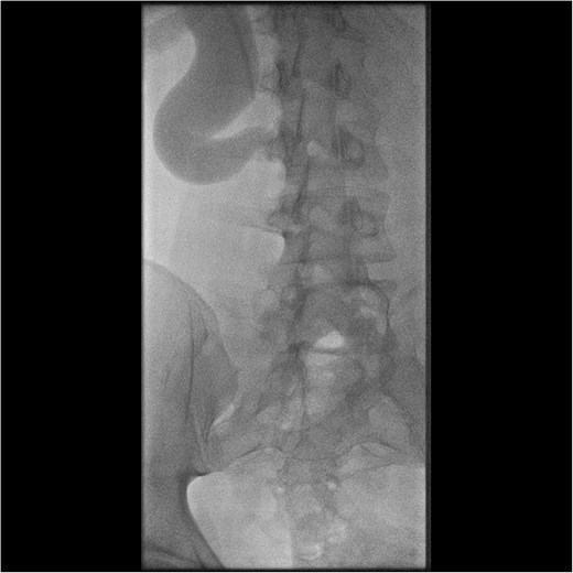 Interventional image during nephrostomy placement demonstrating S-shaped ureter and clear point of obstruction.