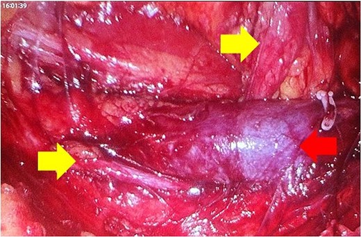 Mobilization of the ascending colon medially has exposed the IVC (red arrow) and the ureter (yellow arrows). Note how the ureter passes behind the IVC. The gonadal vein needed to be removed. Note the hem-O-Lok clip on the vein coming off the IVC.