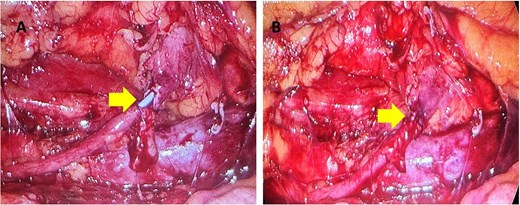 (A, B) The yellow arrow is pointing to incomplete uretero-ureteral anastomosis. The blue JJ stent is visible. In Fig. 5(B) the anastomosis is complete.
