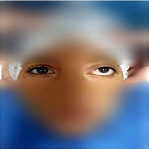 Preoperative image of the patient showing proptosis and exophthalmia in the left eye.