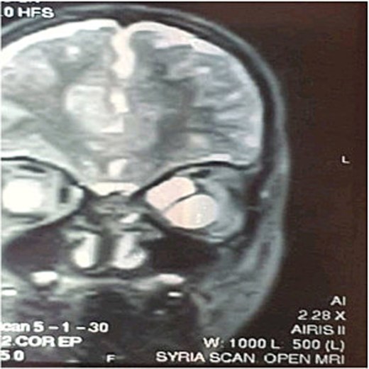 Coronal magnetic resonance cystic lesion images showing cystic lesion in the left orbit.