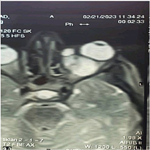 Magnetic resonance cystic lesion images showing cystic lesion in the left orbit.