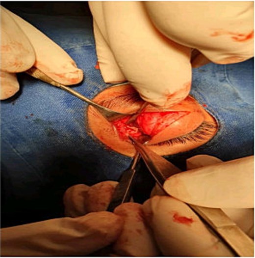 The anterior orbitotomy approach.