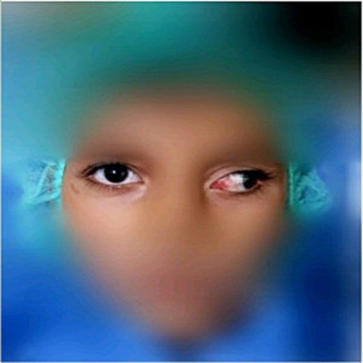 Exophoria in the left eye 6 months after the operation.