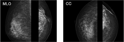 Chest radiograph (frontal view). No obvious abnormal findings were observed in the right breast.