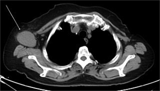 Chest computed tomography (CT) findings. A lymph node enlarged to 46 × 34 mm was observed in the right axilla.