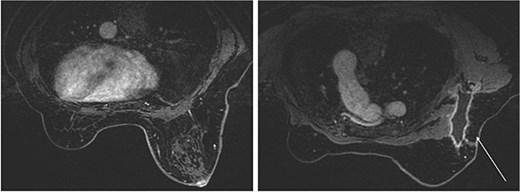 Breast magnetic resonance imaging (MRI) findings. No lesions were observed in the right breast, and a lymph node enlarged to 46 × 34 mm was observed in the right axilla.