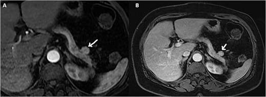 Axial gadolinium contrast T1 weighted images arterial (A) and portal phase (B) showing a small mass adjacent to the tail of the pancreas with intense arterial enhancement.