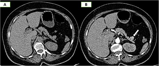 Axial sections of an abdominal non-contrast CT scan (A) and in the arterial phase (B) reveal a nodule adjacent to the tail of the pancreas that is hypervascular on arterial phase and follows the same pattern of enhancement as the spleen.