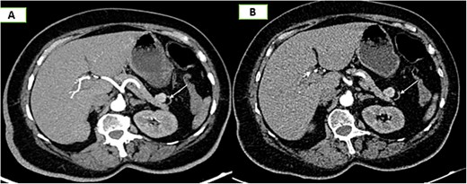 Axial sections of an abdominal CT scan in the arterial phase (A) and vascular reconstructions (B) demonstrate the vascularization of the accessory spleen through its pedicle.