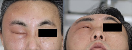 Photography of the right periorbital facial swelling upon presentation to the emergency department.