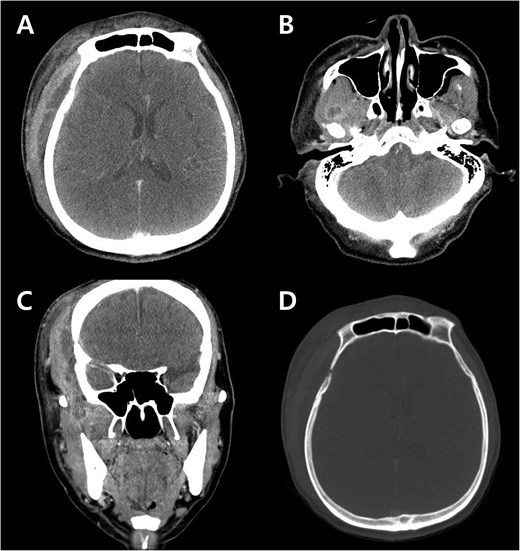 Preoperative contrast-enhanced CT images at emergency department. (A) Axial image shows a lobulated fluid collection beneath the scalp and temporalis muscle, with adjacent dural thickening below the suspected bony defect. (B) Axial image demonstrates cellulitis and abscess formation in the lateral pterygoid muscle. (C) Coronal image depicts the lateral pterygoid abscess extending through the lateral masticator space to involve the temporalis muscle. (D) Axial image shows bony erosion and bony defect of the right lower frontal bone.