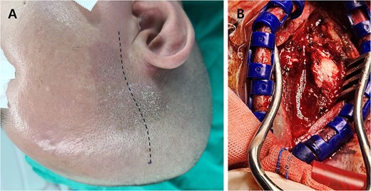 (A) Preoperative photograph with the planned skin incision (dotted line). (B) Intraoperative image after temporalis muscle incision, revealing swollen and necrotic muscle tissue with purulent fluid.