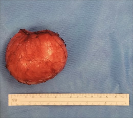 Excised EIC from natal cleft measuring 7 cm in diameter.