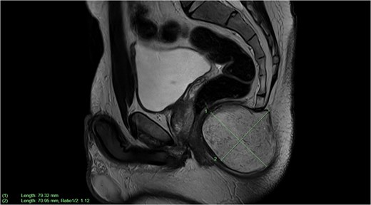 Sagittal plane MRI image of large subcutaneous cystic structure compressing on the anal canal—measuring 7.9 × 7.1 cm in size.