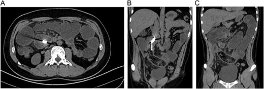 (A) CT, dilation of small bowel loops is seen with obstruction and a hyperdense image in the bowel. (B) CT, reveals a spongiform pattern of mixed mass with gas bubbles inside the intestine. (C) CT, reveals a spongiform pattern with dilated bowel.