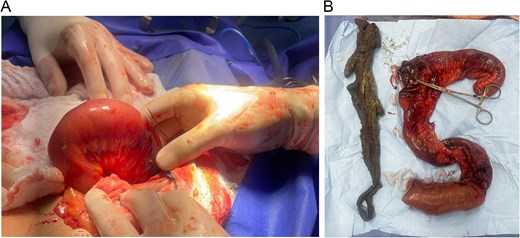 (A) Laparotomy, compromised bowel wall with the foreign body inside its lumen. (B) A whole surgical pad is found within the bowel.