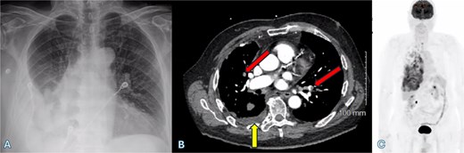 (A) Chest X-ray shows a right-sided pleural effusion. (B) Axial CT scan demonstrates pleural effusion (upward arrow) and bilateral pulmonary emboli (oblique arrows). (C) PET-CT scan shows right-sided pleural nodularity, metabolically active malignancy, and metastasis within the right pleural effusion.