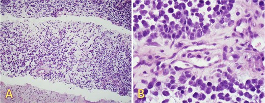 Right pleural biopsy: (A) sheets of metastatic cells H&E (×40), (B) round to oval malignant cells with eosinophilic cytoplasm, no melanin pigmentation was detected H&E (×400).