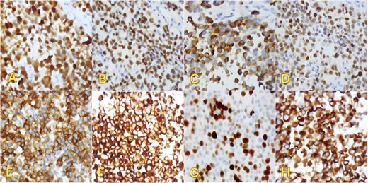 Immunohistochemical staining (×400). Pleural biopsy was strongly positive for (A) S100, (B) SOX10, (C) Melan-a, (D) MITF, (E) CD99, (F) BCL2, (G) Ki67, and (H) WT1.