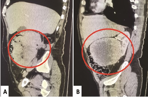 Abdominal CT-scan post-nephrectomy: Heterogeneous colonic tumor without renal recurrence (A). Initial abdominal CT-scan: Right renal mass pushing the ascending colon without any evidence of invasion (B).