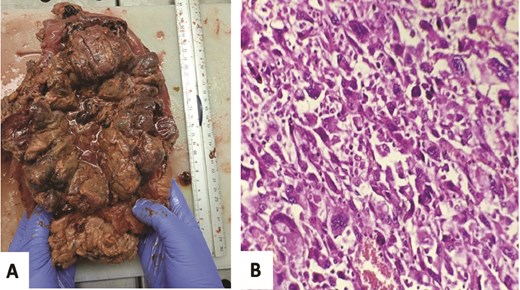 Gross examination: Red-brownish polypoid and stenotic mass with significant hemorrhagic and necrotic changes (A). Microscopic analysis: Undifferentiated proliferation showing pleomorphic large cell without any epithelial carcinoma component, especially no conventional CRCC pattern seen (HE, 400×) (B).
