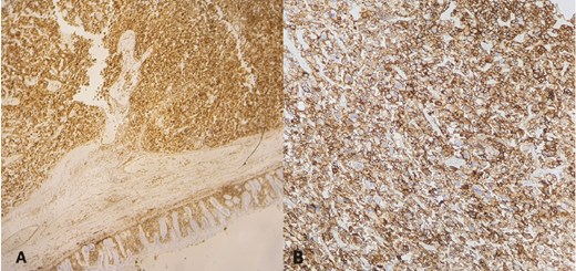 Immunohistochemical staining: diffuse and strong immunoreactivity of tumor cells for CD10 (A) and vimentin (B).