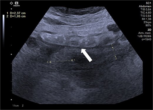 Ultrasound of the right iliac fossa showing the cecal appendix (arrow), measuring 1.1 cm in diameter with a wall thickness of 0.34 cm. It demonstrated increased vascularity and non-collapsibility with compression.