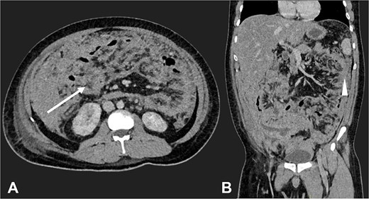 Contrast-enhanced CT in the venous phase: Axial view (A) and coronal reconstruction (B) demonstrated nodular thickening of the peritoneum with vascular enhancement, peritoneal implants measuring up to 6 mm (arrow), and plaque-like implants along the splenic margin (head arrow).