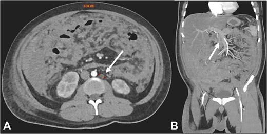 Contrast-enhanced CT in the arterial phase: Axial view (A) and coronal reconstruction (B) demonstrated mesenteric lymphadenopathy measuring up to 1.53 cm (white arrows).