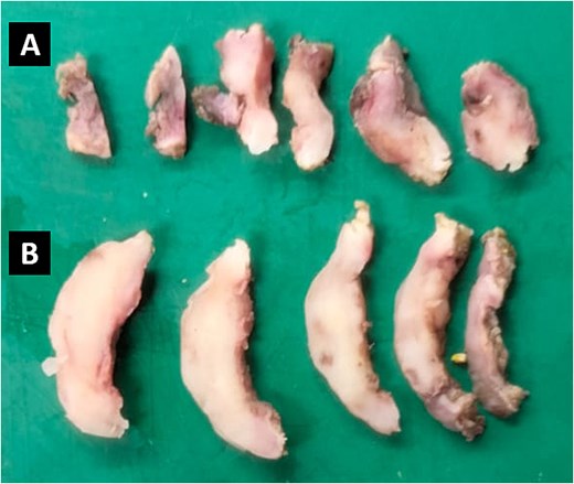 Representative sections of two tissue samples from the parietal peritoneum. The smaller fragment (A) measures 2.0 × 1.0 × 0.3 cm, has an irregular oval shape, and exhibits a soft consistency. The larger fragment (B) measures 3.5 × 2.0 × 0.3 cm, has an irregular laminar shape, and is similarly soft.