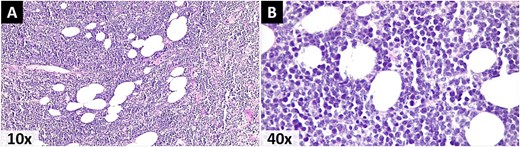 Photomicrographs stained with Hematoxylin and eosin. A) A malignant lymphoproliferative neoplasm infiltrating the omental adipose tissue, morphologically consistent with NHL. B) Small cells with scant eosinophilic cytoplasm, pleomorphic nuclei with dispersed granular chromatin, prominent nucleoli, and atypical mitoses.