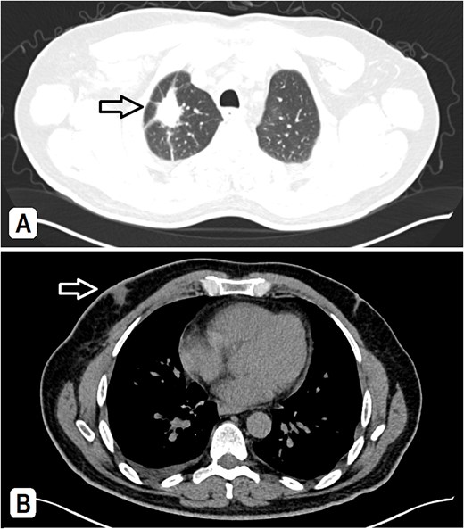 (A) A CT scan showed a spiculated lesion in the right lung apex with adjacent atelectatic bands, pathologically enlarged hilar, mediastinal, and right-sided axillary lymph nodes, the largest measuring 1.5 cm. (B) The mediastinal window of CT at the chest level shows an asymmetry of breast tissue with right-sided retro-areolar soft tissue density.