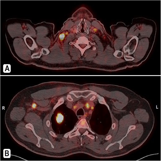 PET-CT scan. (A) At the neck level showing intensely hypermetabolic enlarged cervical lymph nodes. (B) An intensely hypermetabolic right upper lobe lung mass, with metastatic right axillary and mediastinal lymph nodes.