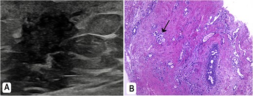 (A) Breast ultrasound showed a right-sided retro areolar irregular antiparallel infiltrative hypo-echogenicity. A biopsy was taken from it. (B) H&E: The breast tissue is infiltrated by large neoplastic cells; adopting glandular pattern in some places (arrow).