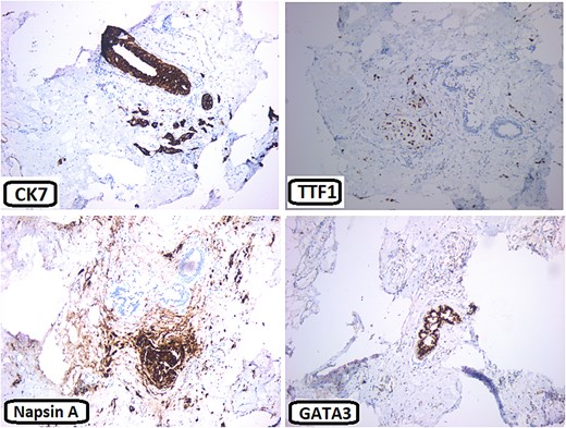 Immunohisochemical stains: The neoplastic cells are positive for CK7, TTF1, and Napsin A. They are negative for GATA3.